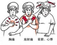 冠心病有哪些癥狀？