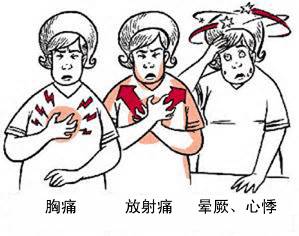 冠心病有哪些癥狀？(圖1)