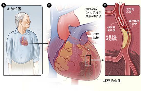 怎樣治療冠心??？(圖3)