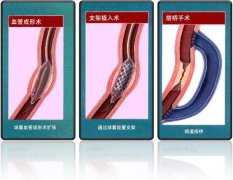 怎樣治療冠心病？
