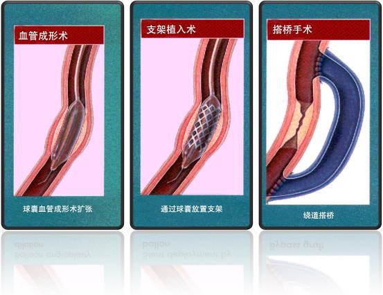 怎樣治療冠心病？(圖1)