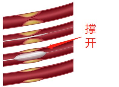 什么是藥物球囊？(圖2)